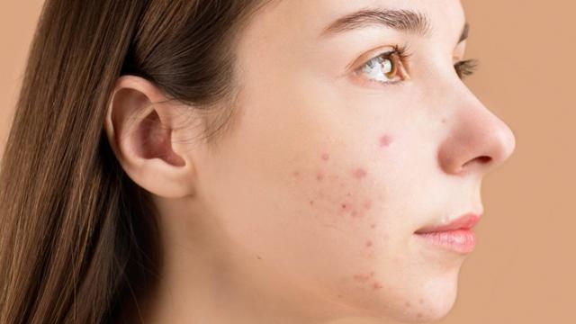 8 motivos pelos quais você está tendo mais acne recorrente