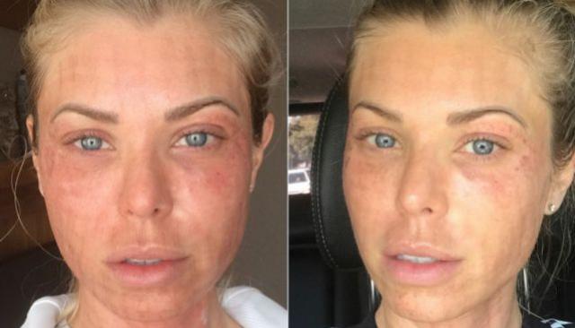 Modelo mostra antes e depois realista de tratamento de beleza: como funciona? Dói?